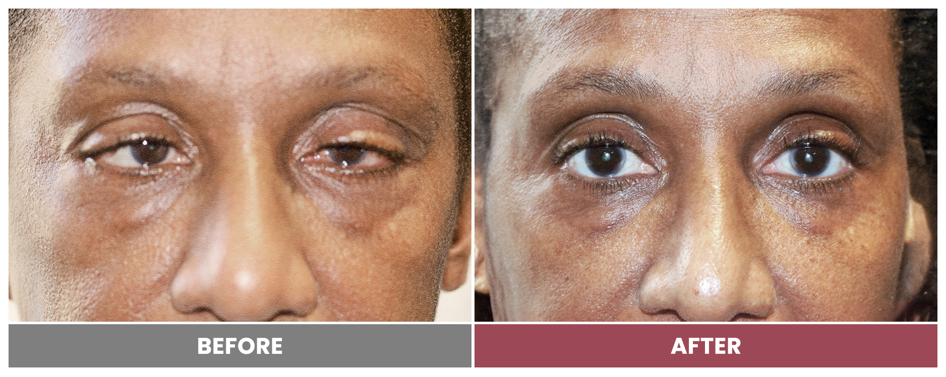 PTOSIS REPAIR - Case 72